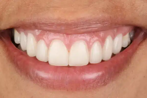 Resultado de carillas de porcelana CAD/CAM y gingivoplastia — sonrisa simétrica y natural sin exceso de encía