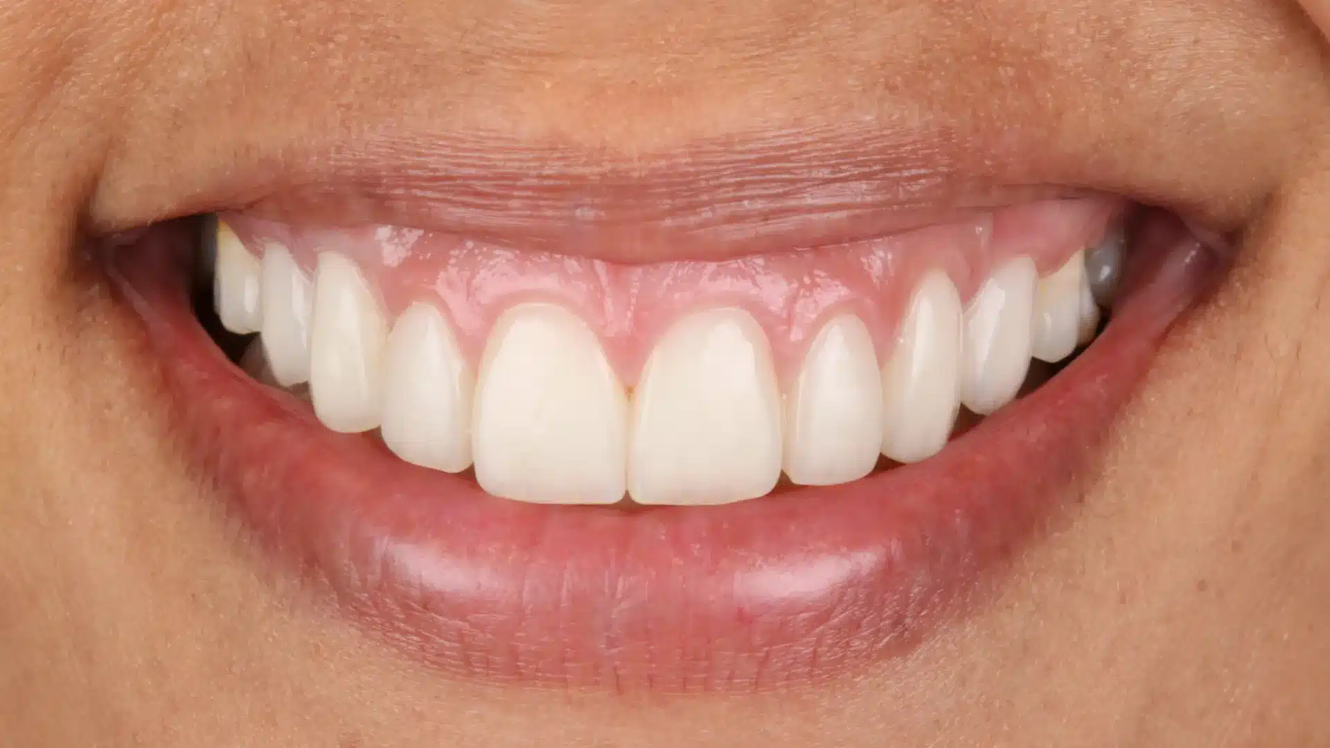 Resultado de carillas de porcelana CAD/CAM y gingivoplastia — sonrisa simétrica y natural sin exceso de encía