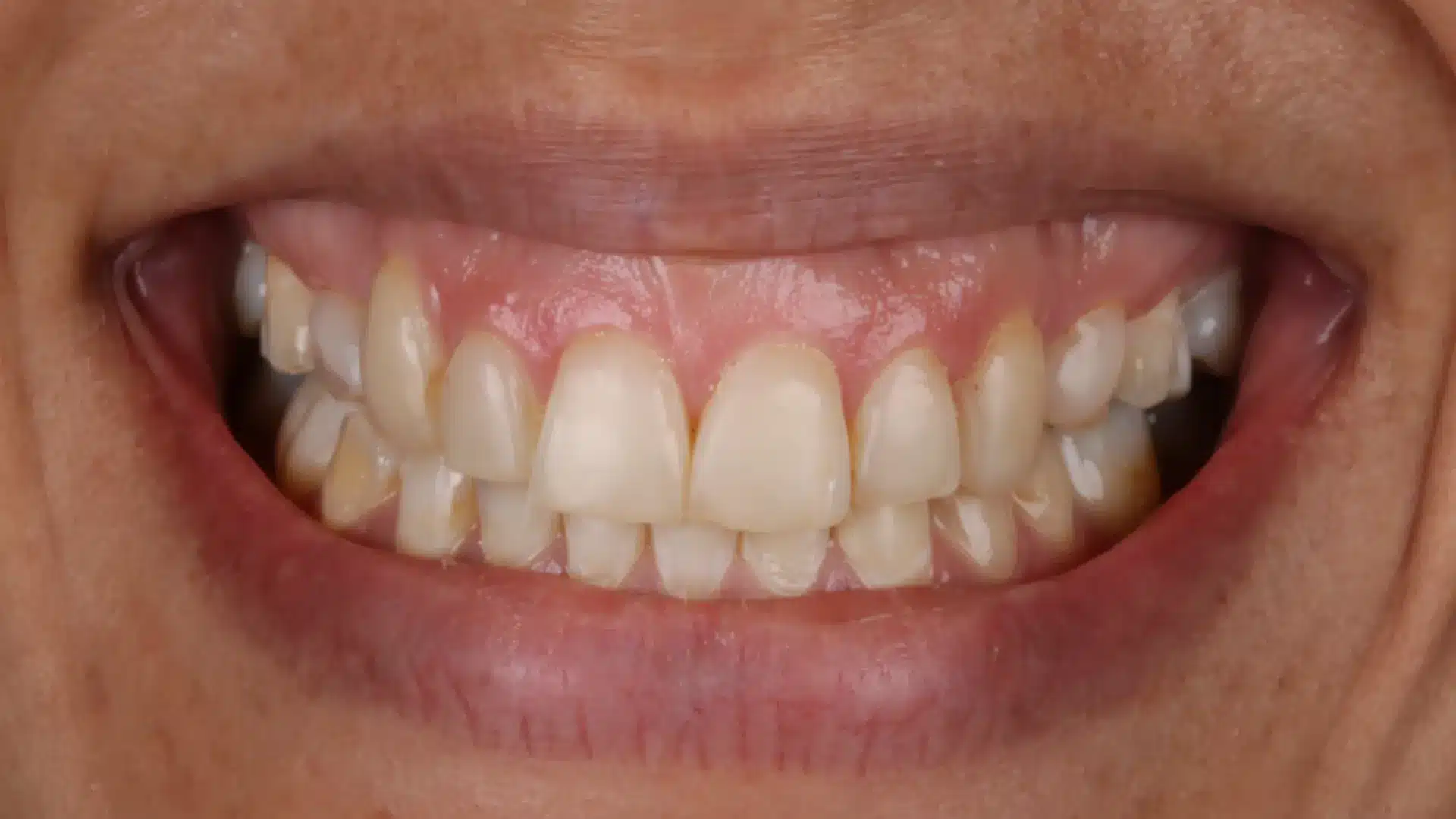 Paciente con carillas de composite desgastadas y excesiva exposición de encía en sonrisa — caso de gingivoplastia y carillas de porcelana en Madrid