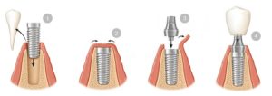 ¿Como se colocan los implantes dentales? - Clínica Ruiz de Gopegui como se colocan implantes - clinica dental ruiz de gopegui