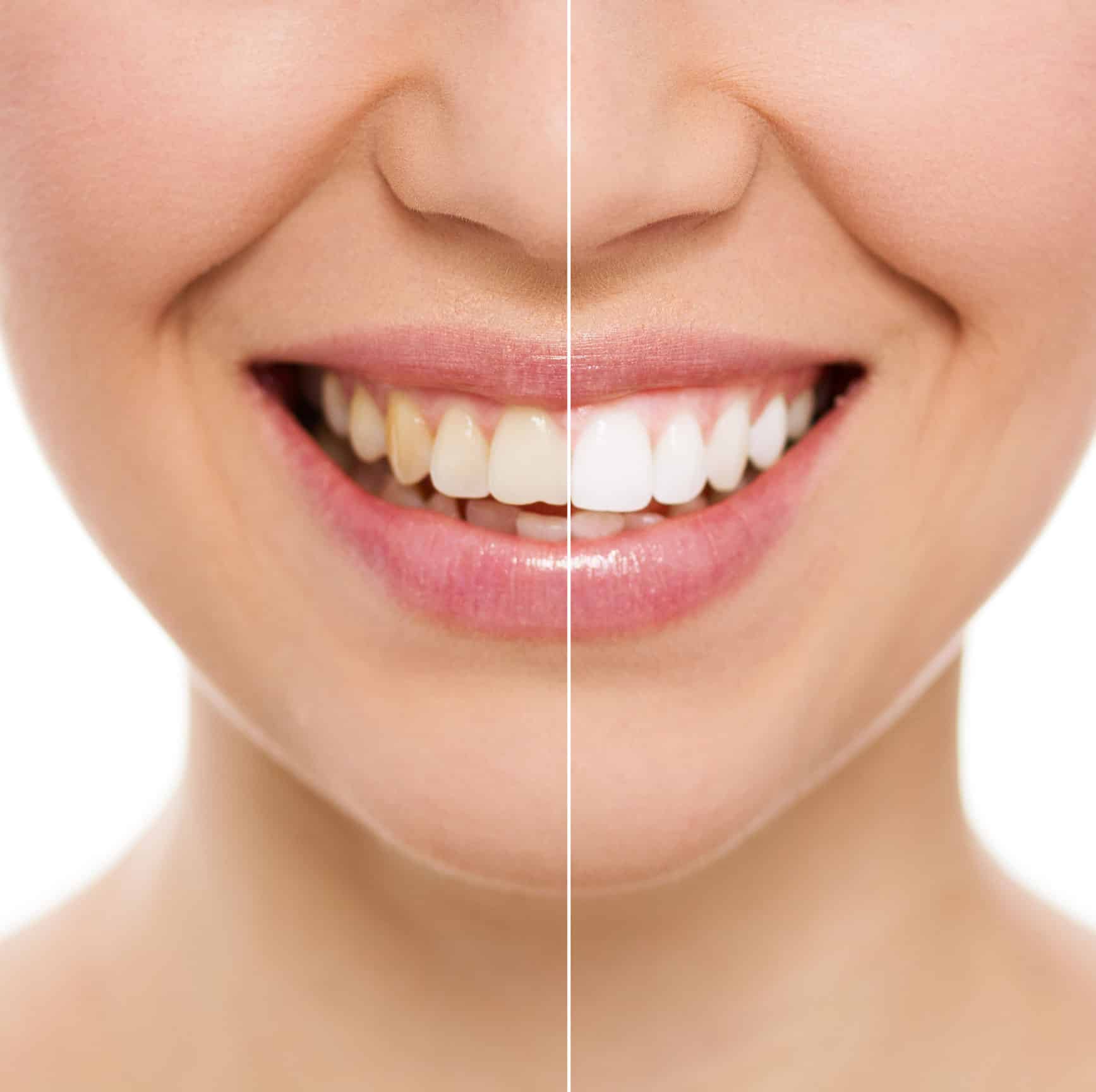 blanqueamiento dental - Clínica Dental Ruiz de Gopegui