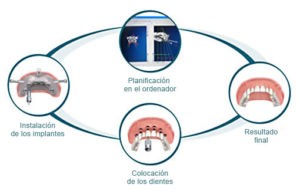 implantes guiados - clinica ruiz de gopegui