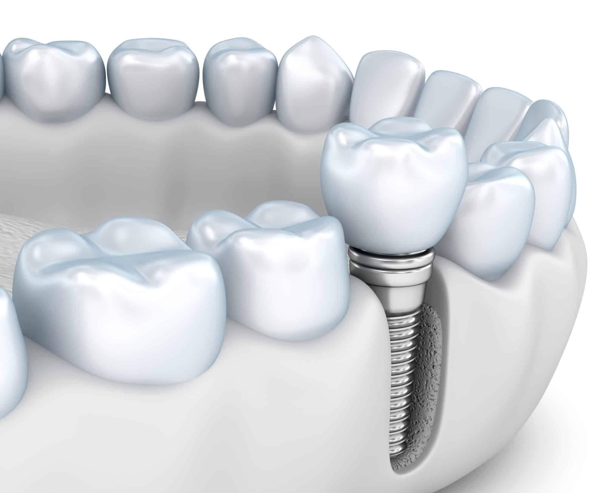 implantes dentales - clínica dental ruiz de gopegui