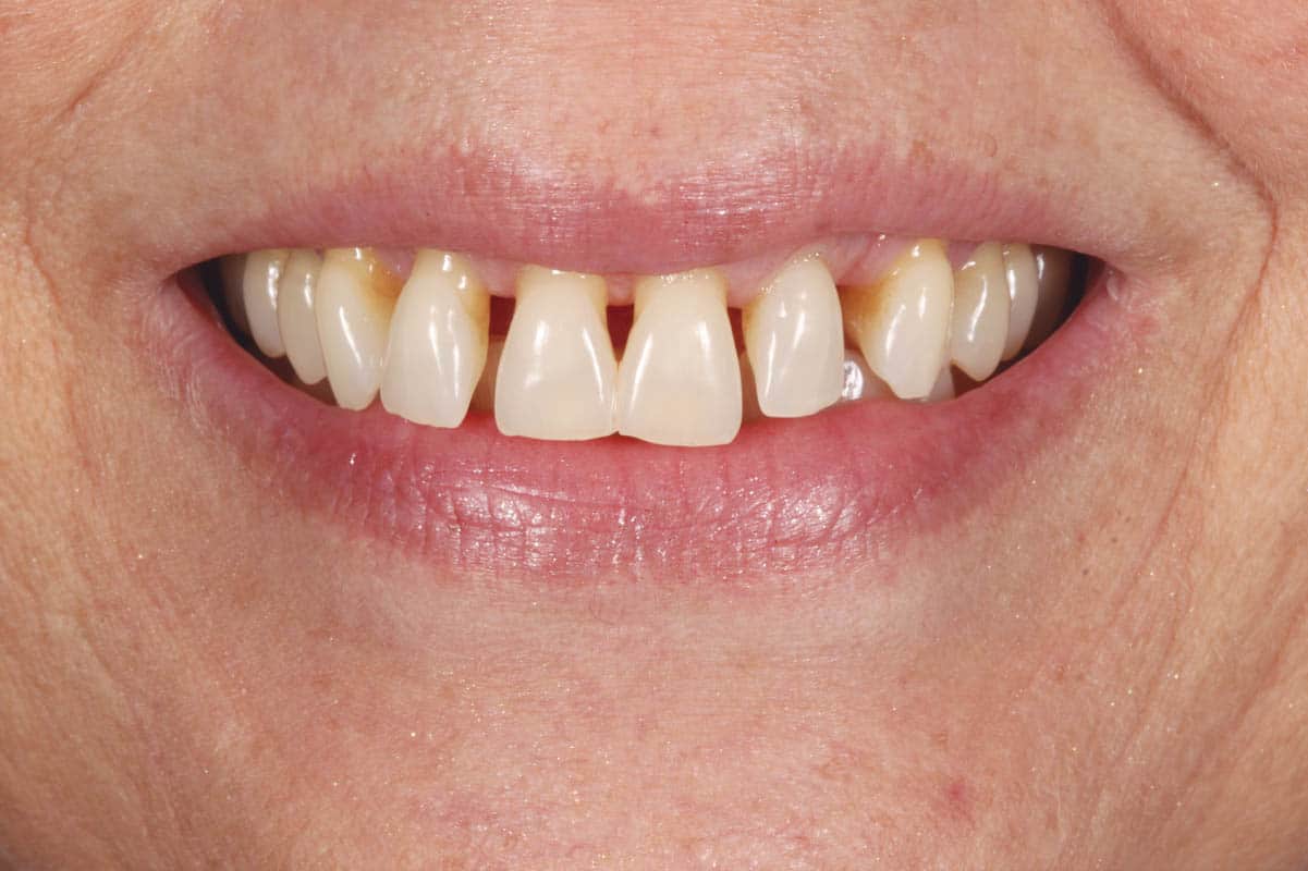Gopegui facetas de porcelana en paciente con secuelas esteticas de causa periodontal