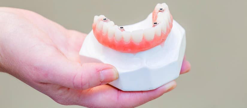 Implantes All on Four (All on 4) - Clínica Ruiz de Gopegui