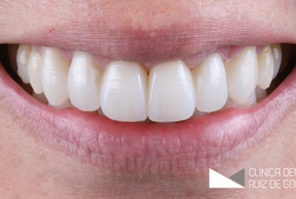 Caso Complejo -Rehabilitacion Facetas Porcelana - Despues