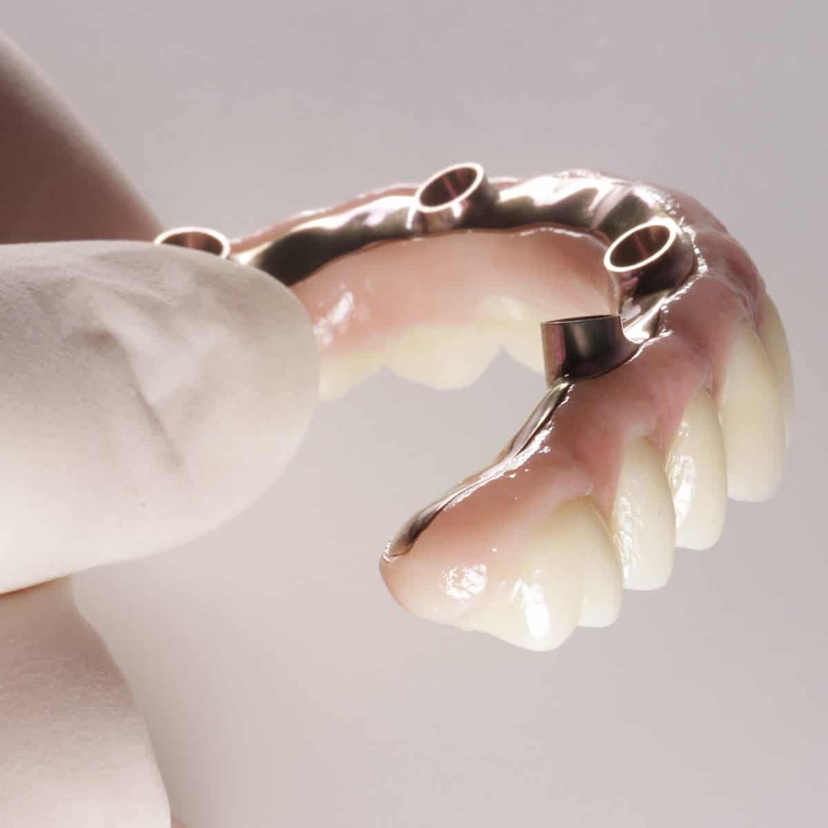Preservación alveolar post-extracción para implante dental en Madrid