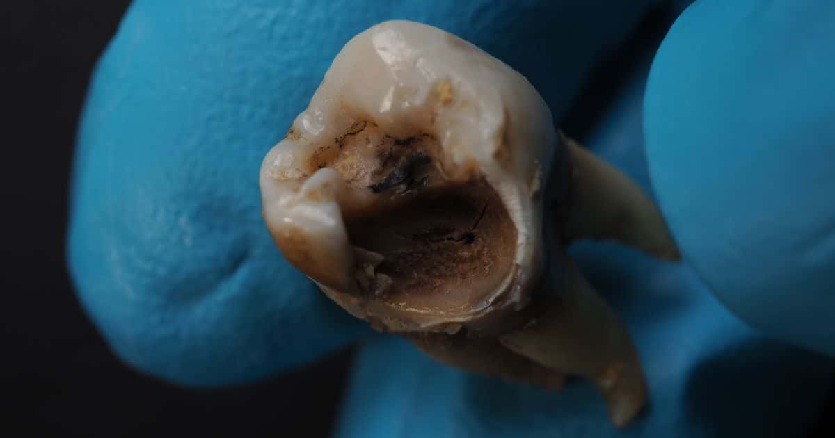 Caries denta