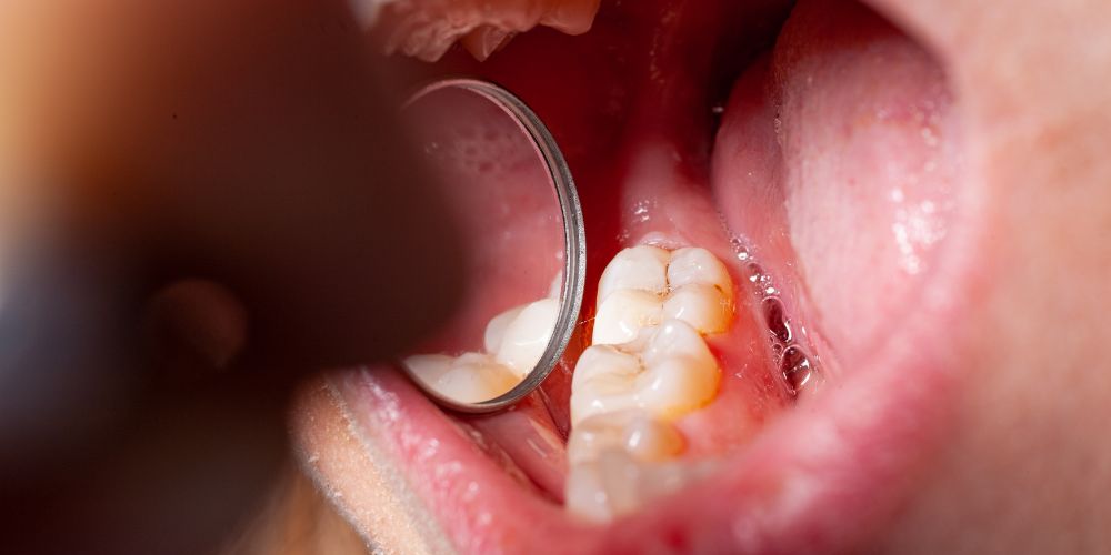 Caries silenciosas