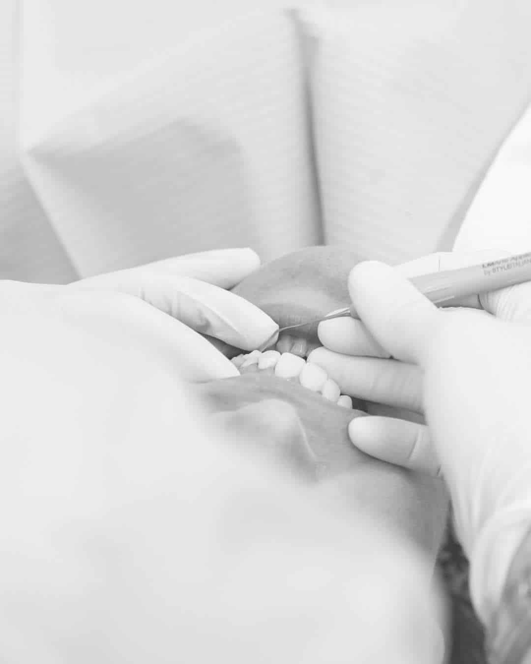 coronas dentales clinica dental ruiz de gopegui