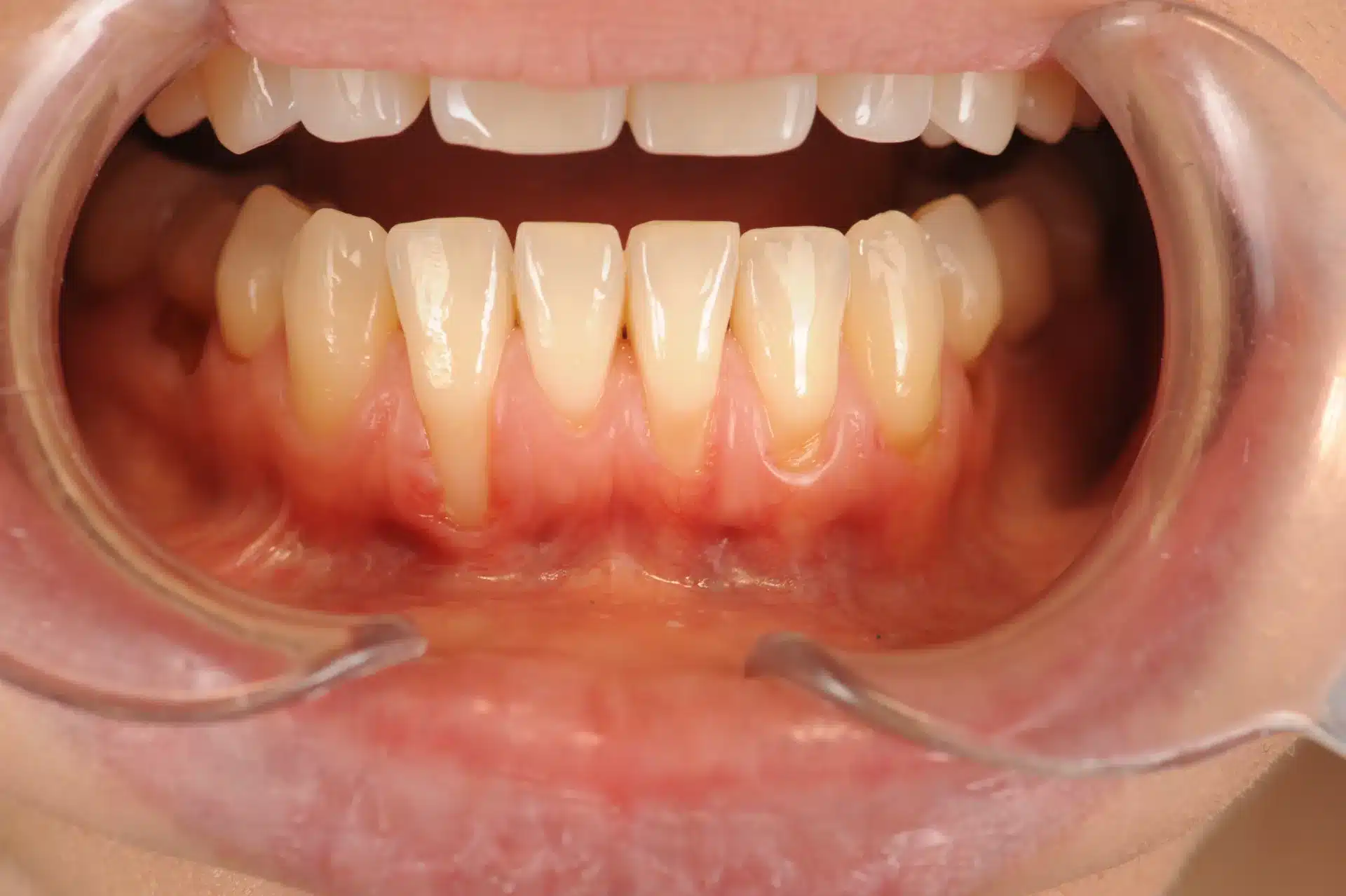 Injerto de encía - Clínica Ruiz de Gopegui Texto alternativo: Fotografía intraoral mostrando recesión gingival severa en los incisivos inferiores con exposición de las raíces dentales y encía retraída.
