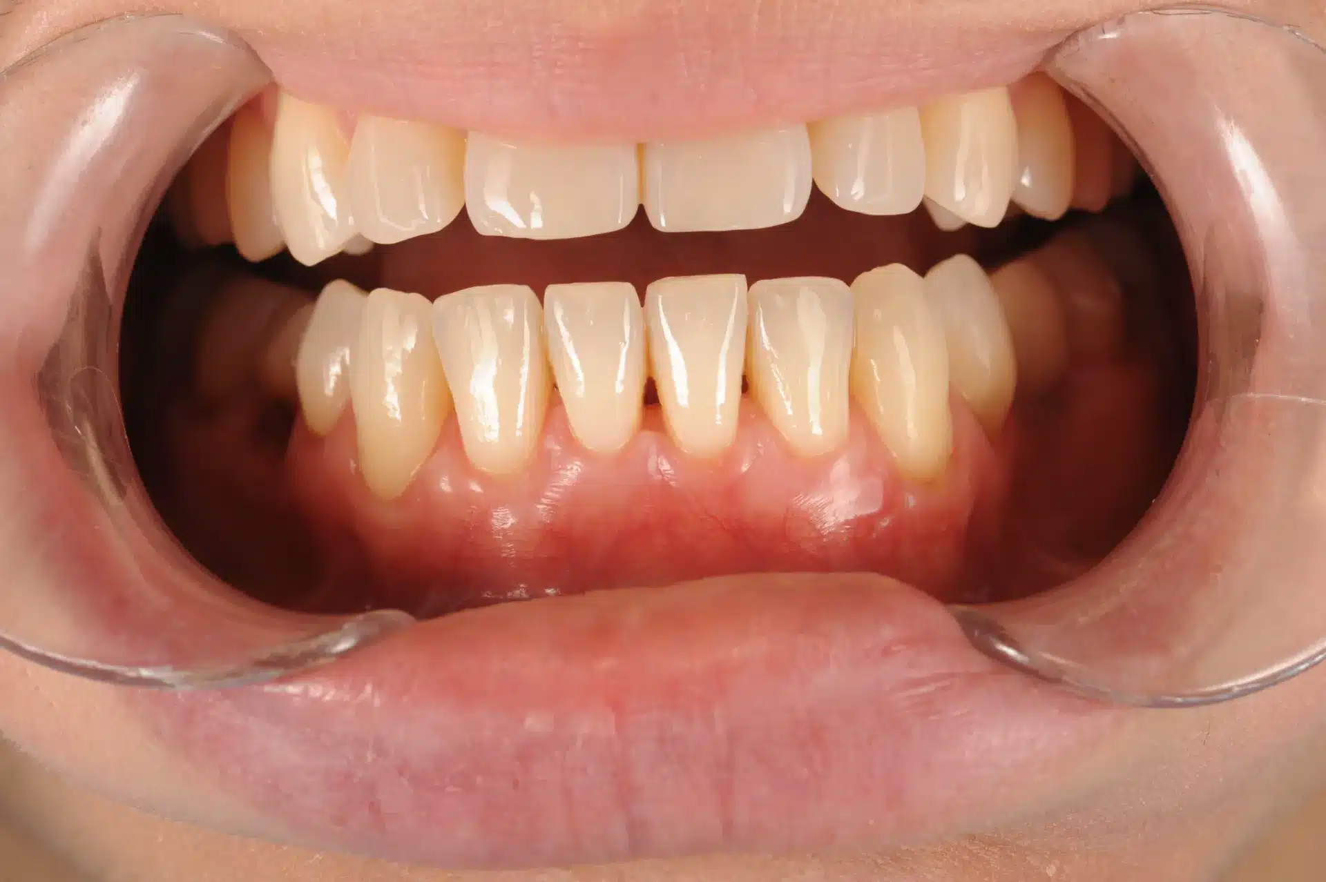 Injerto de encía - Clínica Ruiz de Gopegui Fotografía intraoral tras tratamiento de injerto de encía, mostrando cobertura radicular completa y encía cicatrizada en los incisivos inferiores
