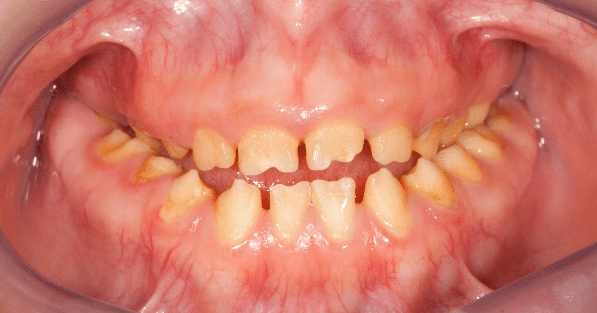 Dentinogénesis imperfecta