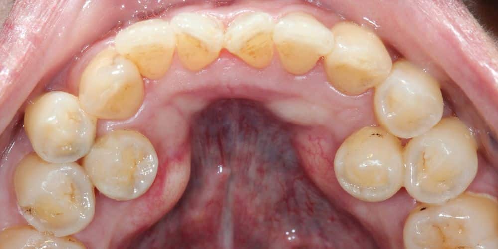 Dientes supernumerarios