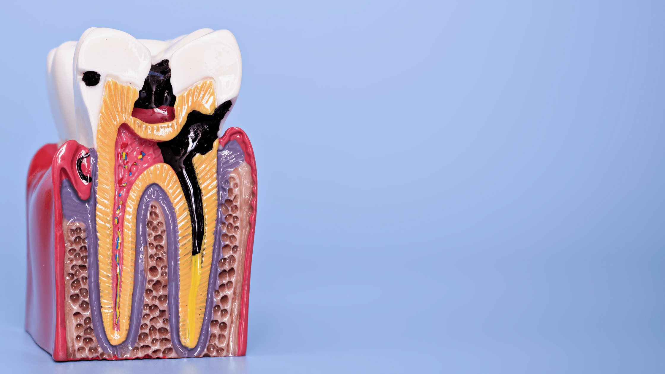 caries avanzada