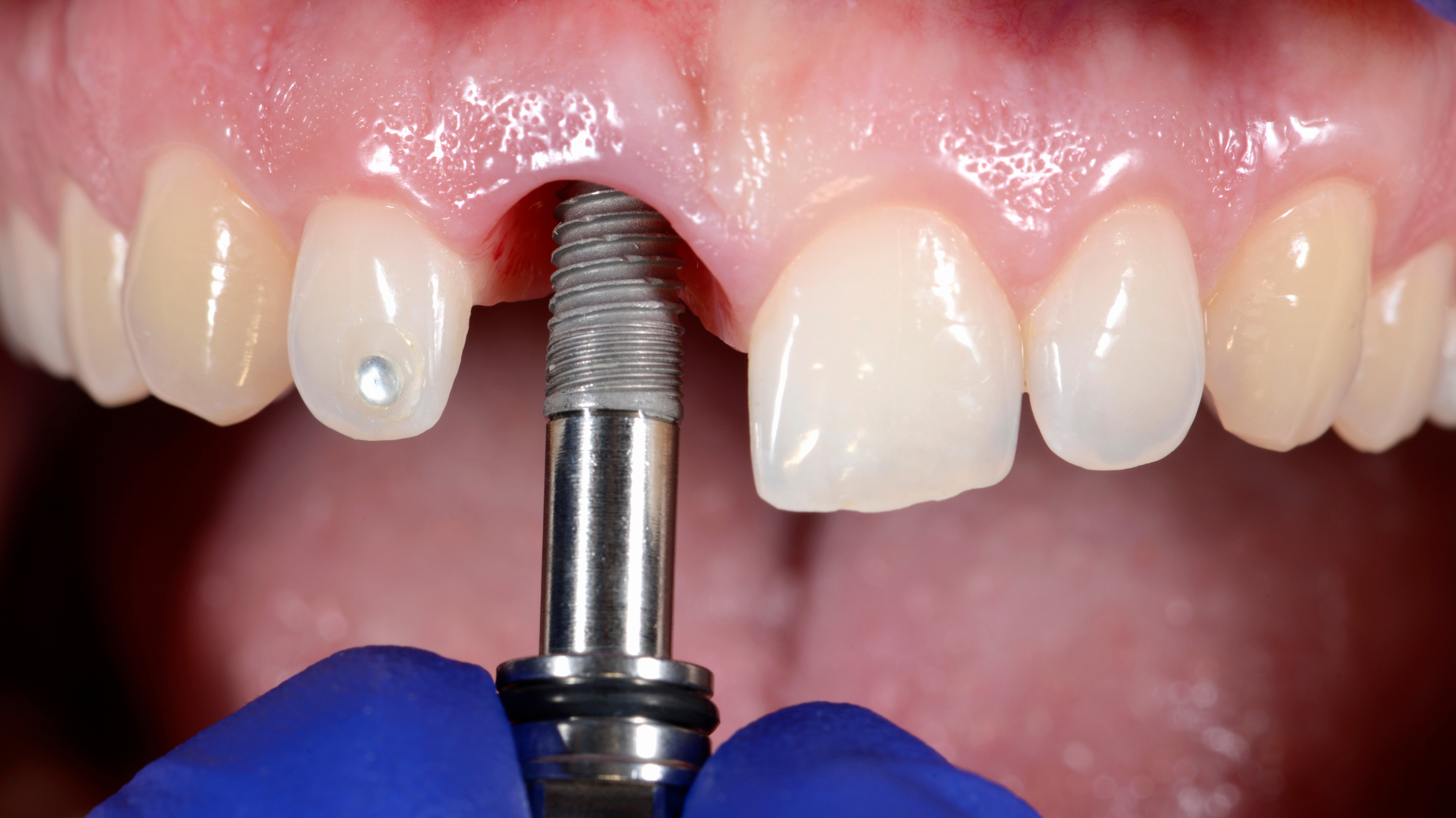 puente dental o implante dental