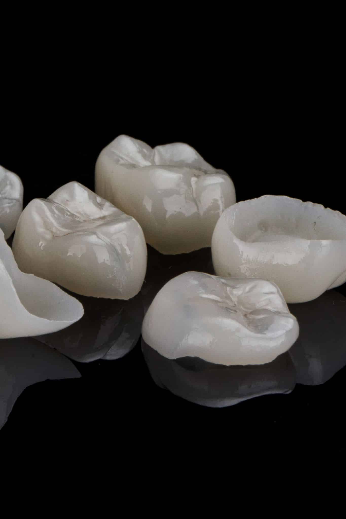 carillas dentales vertical clinica dental ruiz de gopegui
