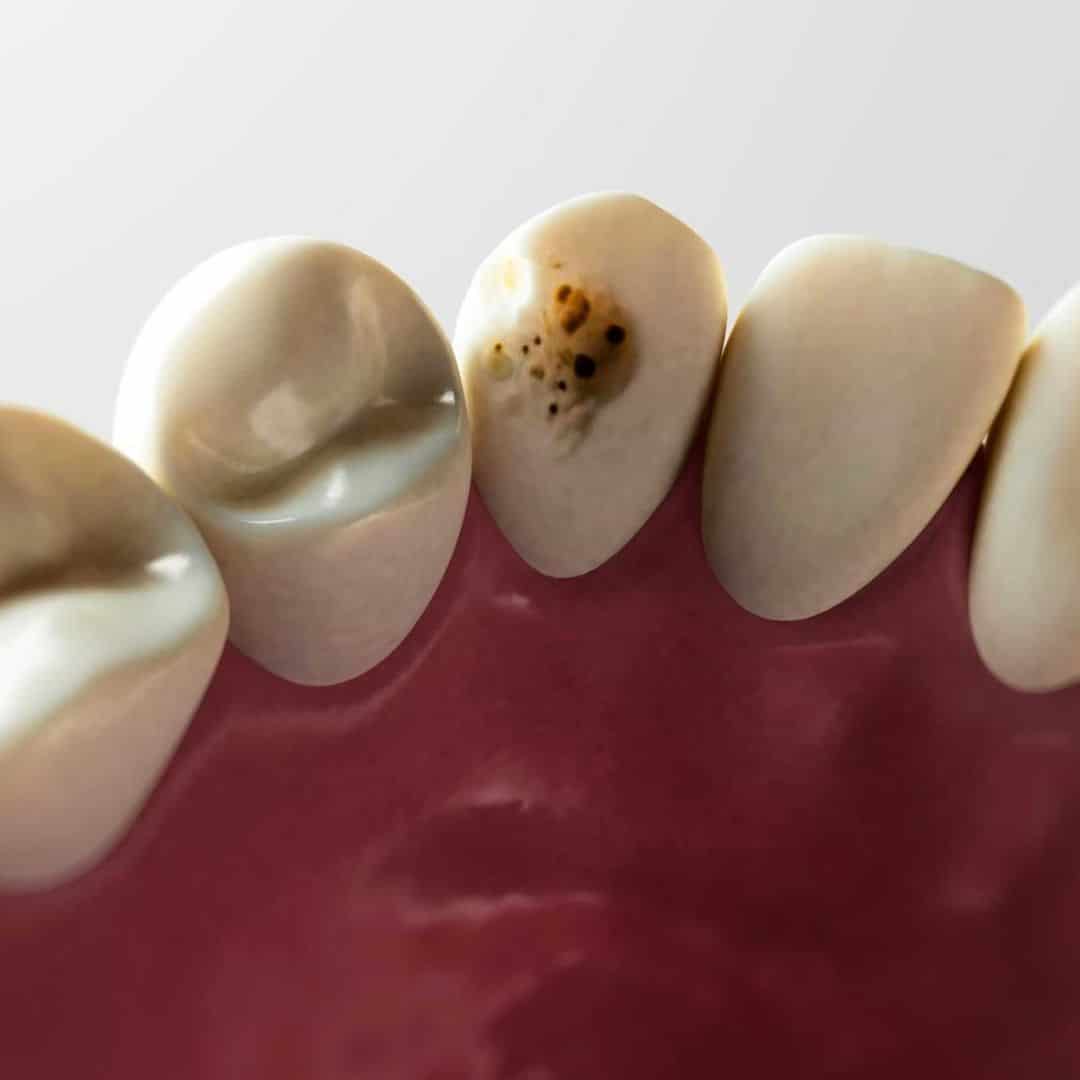 Caries Clinica dental Ruiz de Gopegui