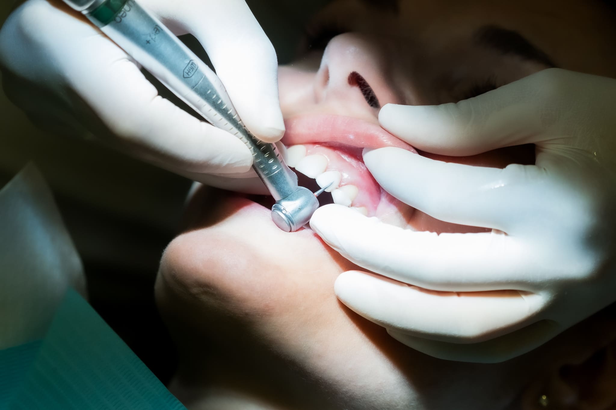 profilaxis básica limpieza dental clínica ruiz de gopegui