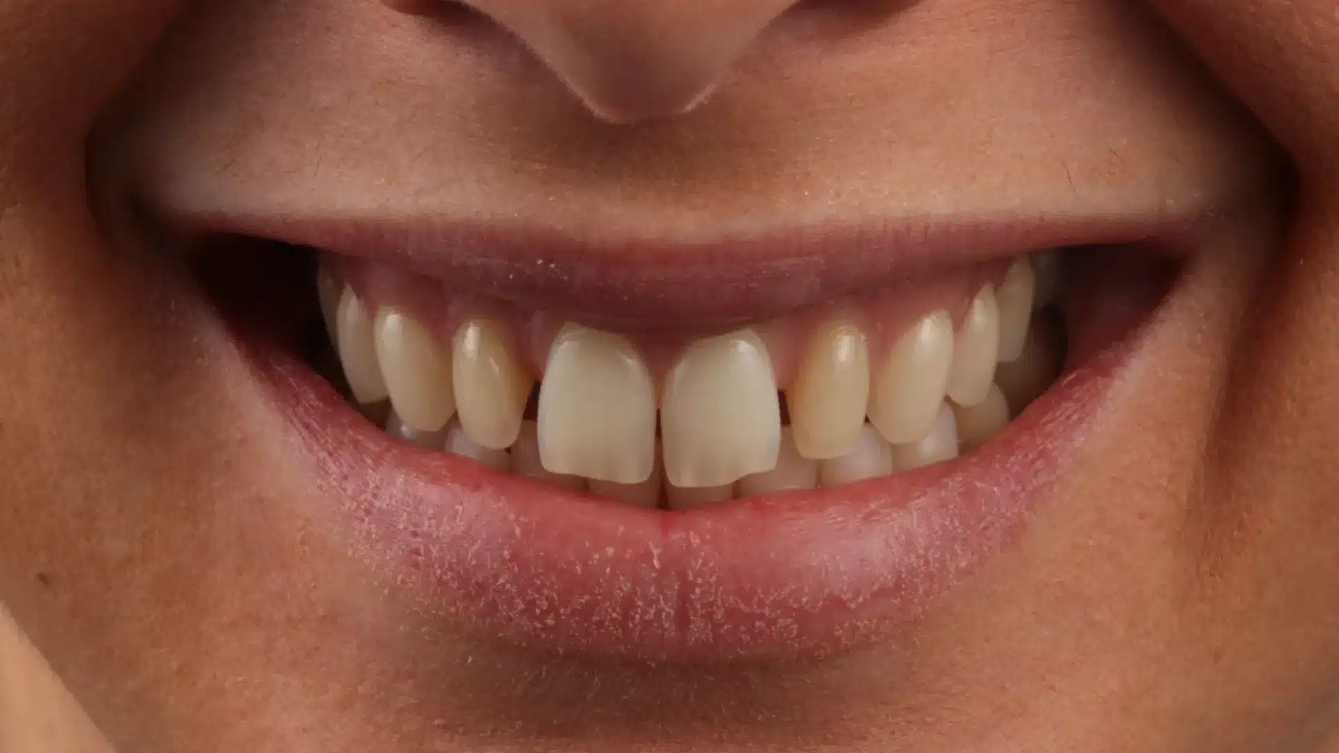 Carillas de Composite - Clínica Ruiz de Gopegui Primer plano de la sonrisa inicial de una paciente joven con diastemas y espacios entre los dientes anteriores.