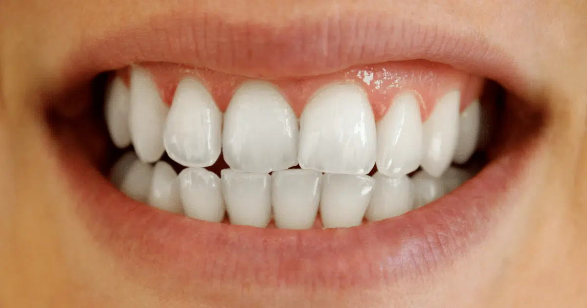 Rechinar De Dientes: Causas, Consecuencias Y Tratamiento