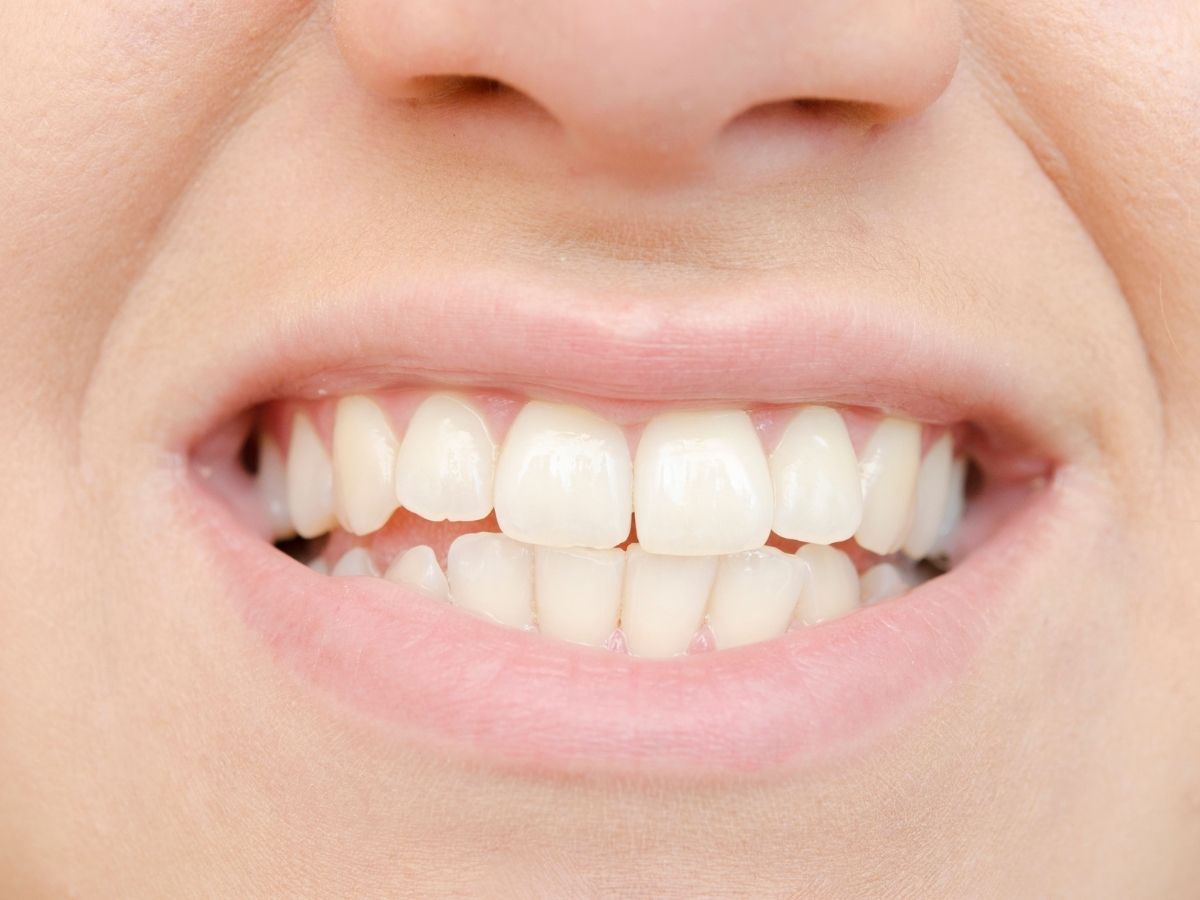 Desgaste dental