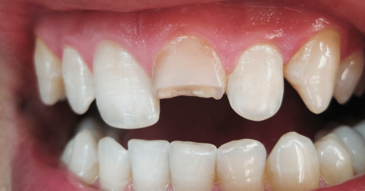 Fractura coronaria