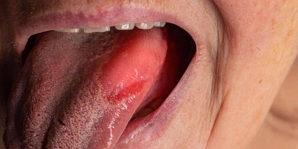 Glositis