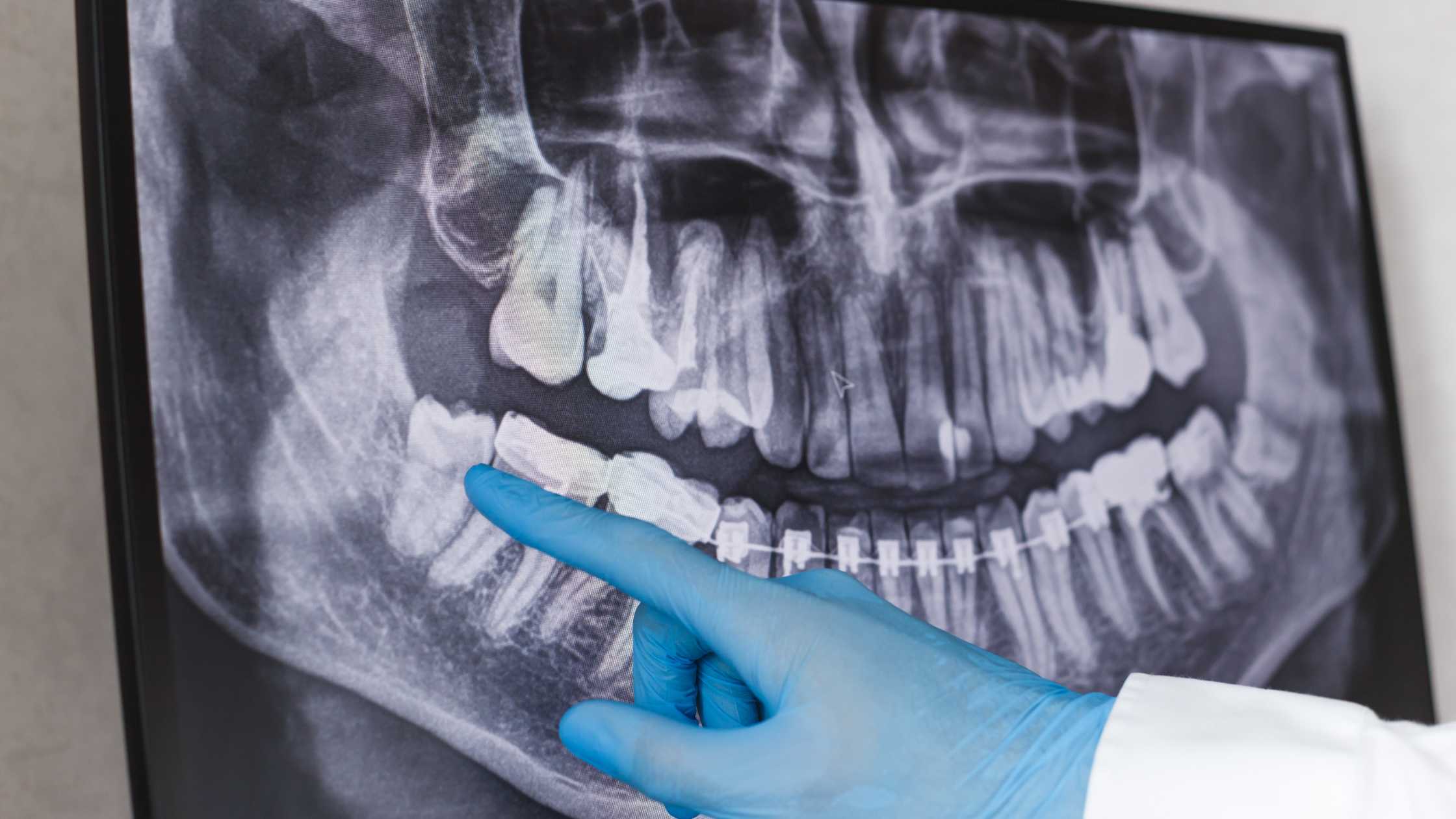 empaste dental clínica dental ruiz de gopegui