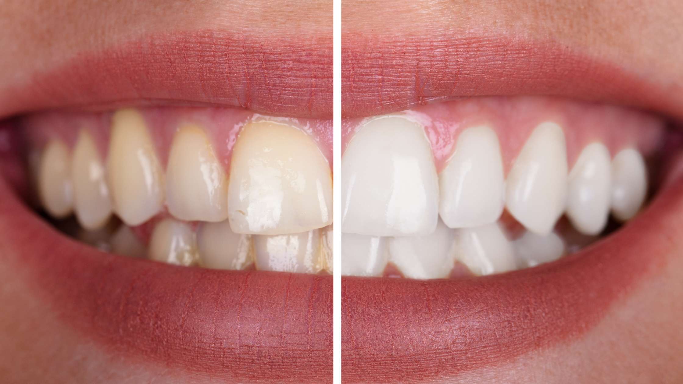 blanqueamiento dental clinica dental ruiz de gopegui madrid