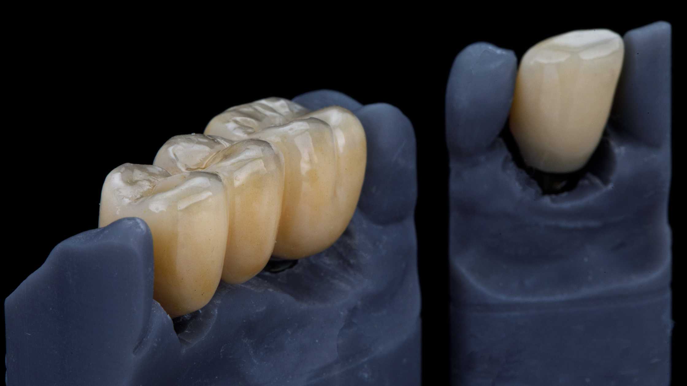 puente dental clínica dental ruiz de gopegui