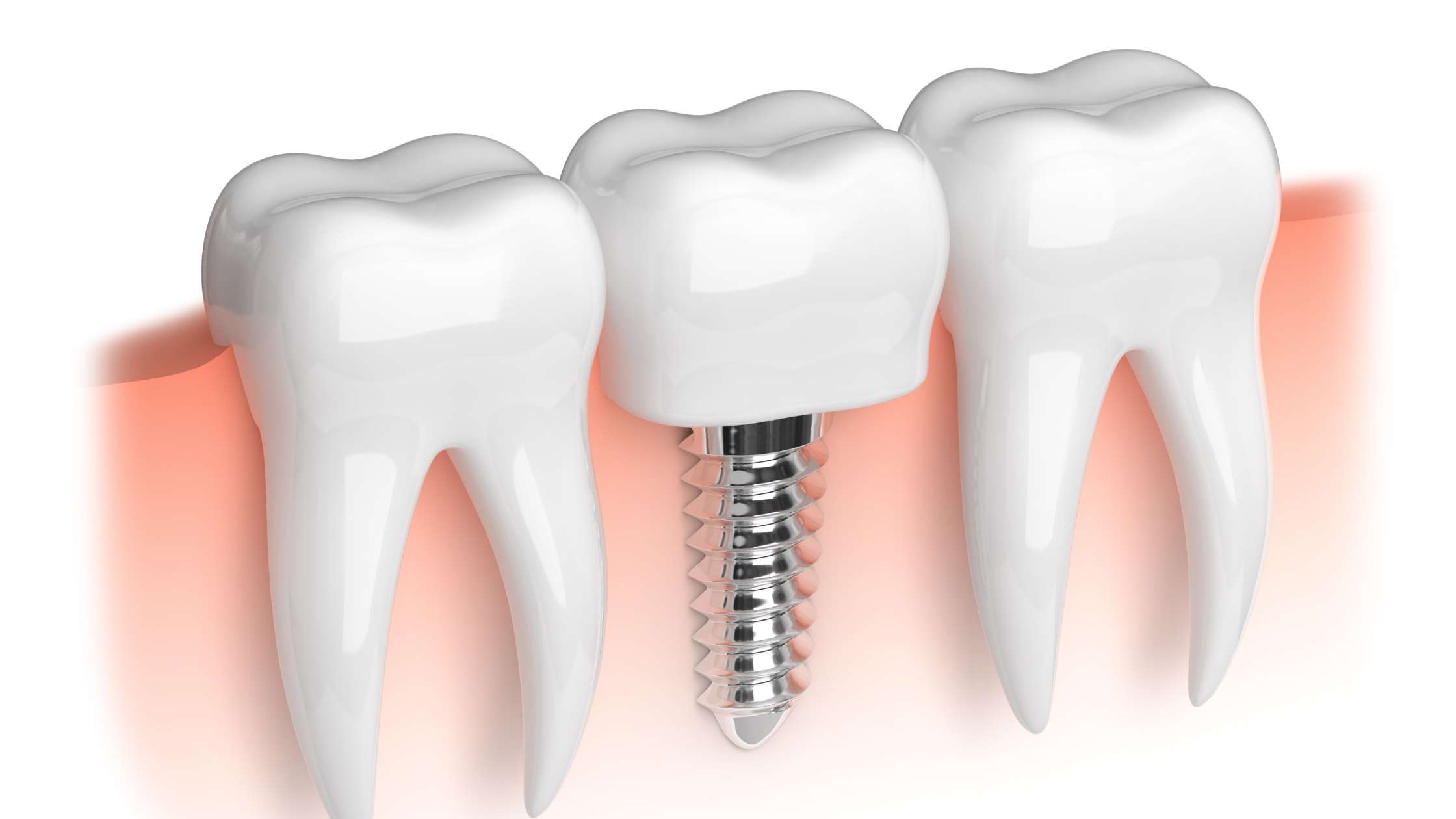 Implantes de carga inmediata - clinica dental ruiz de gopegui madrid
