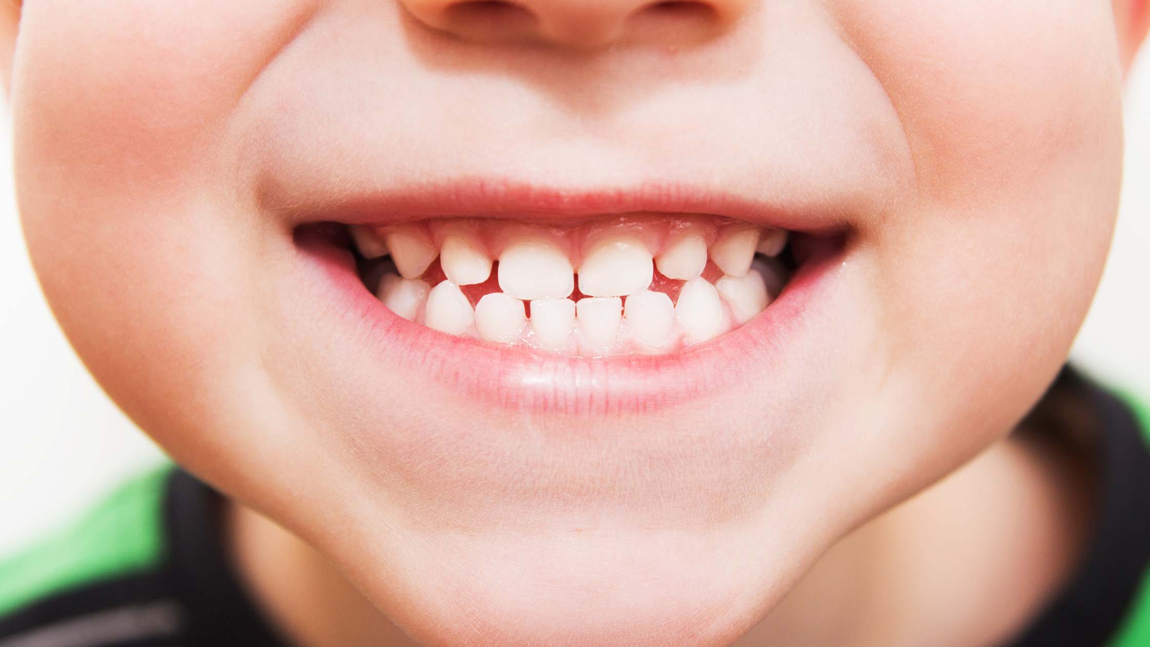 pulpotomía niños odontopediatría clínica dental ruiz de gopegui