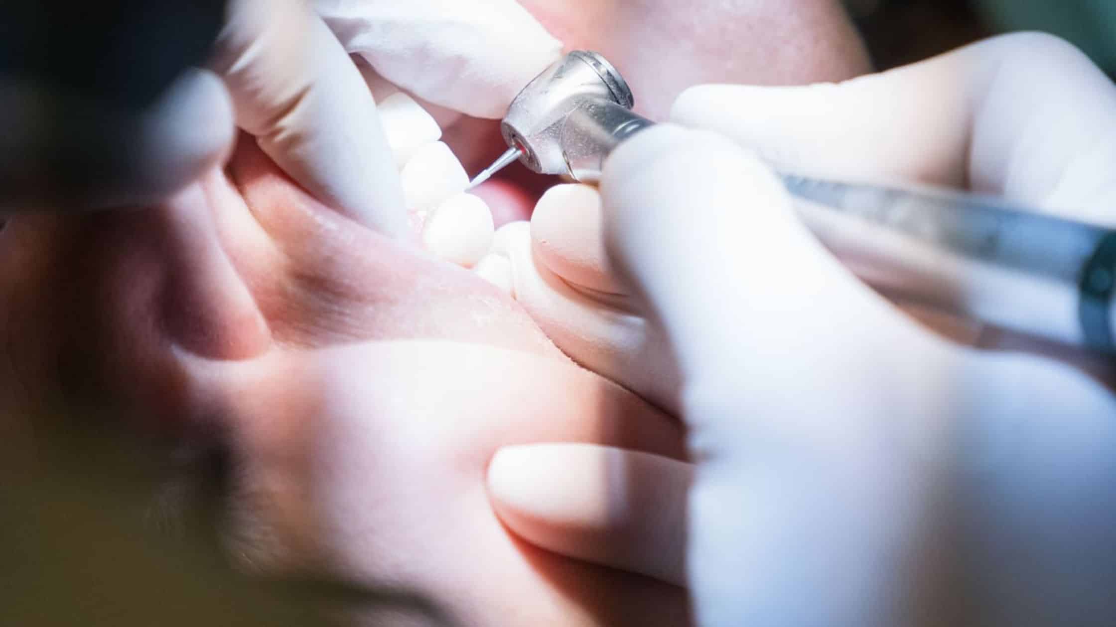 cirugia periodontal periodontitis clínica dental ruiz de gopegui