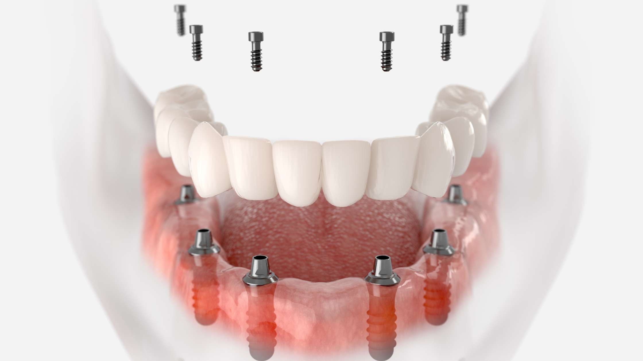 all on 6 y dental ruiz de gopegui