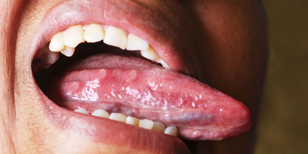 Granos en la lengua