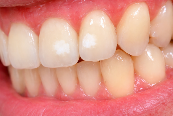 Manchas blancas (white spots) tras ortodoncia: soluciones que sí funcionan - Clínica Ruiz de Gopegui white spots en los dientes