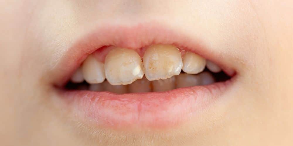 Manchas blancas en los dientes