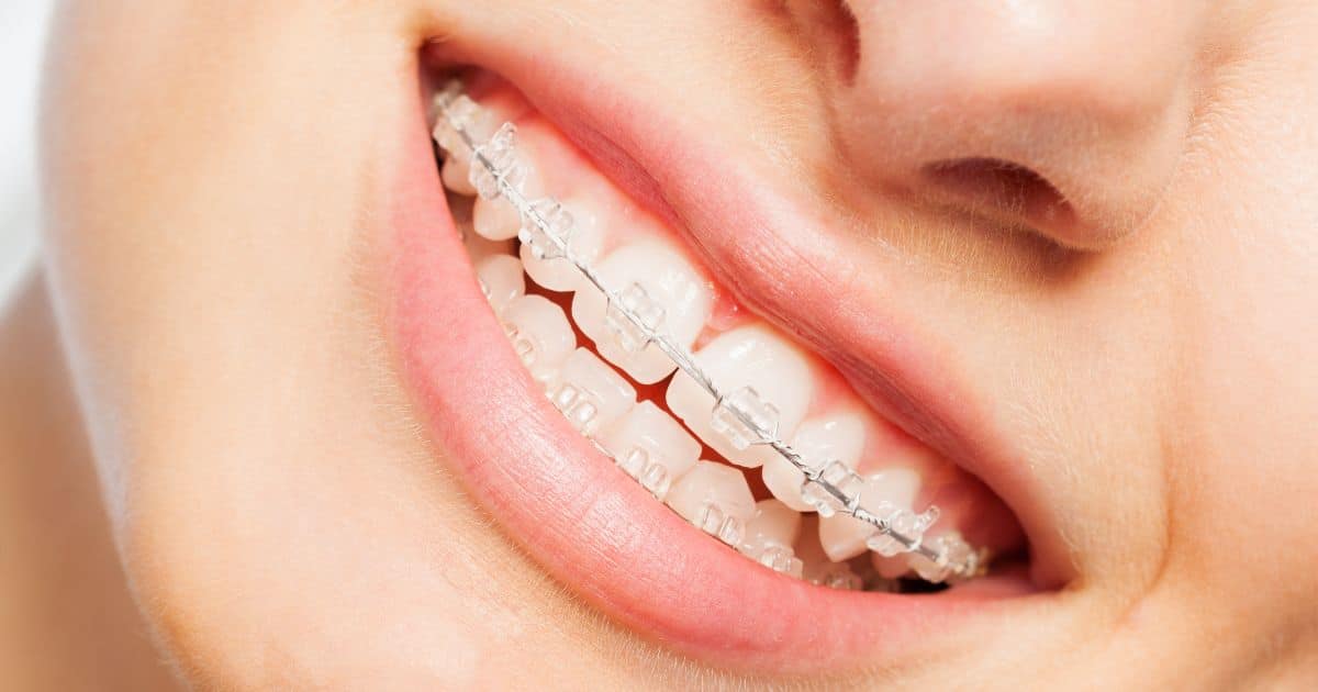 Ortodoncia estética