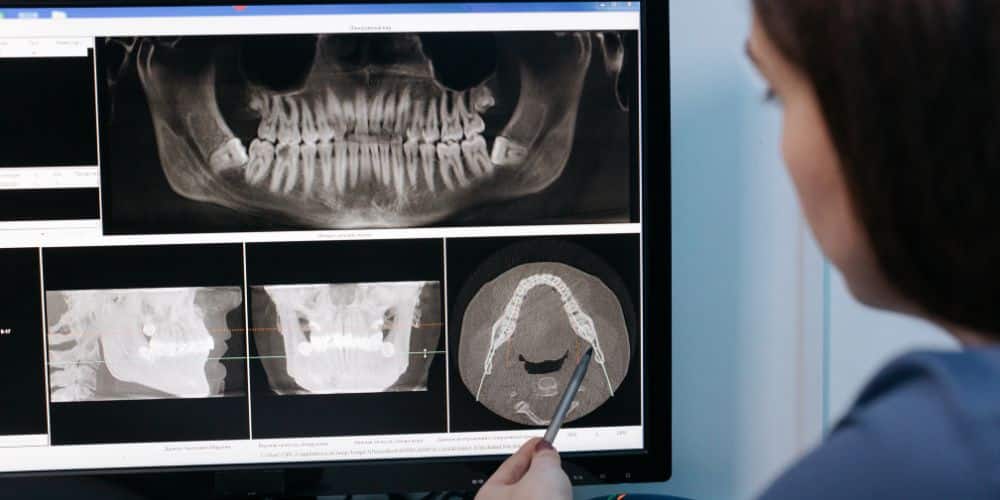 osteomielitis dental