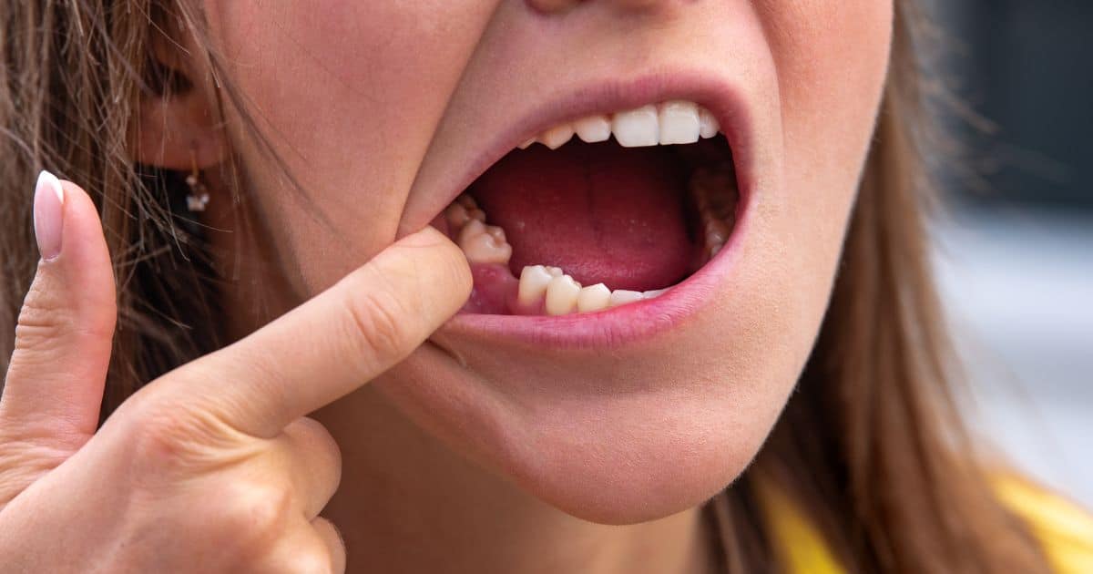 Pérdida dental