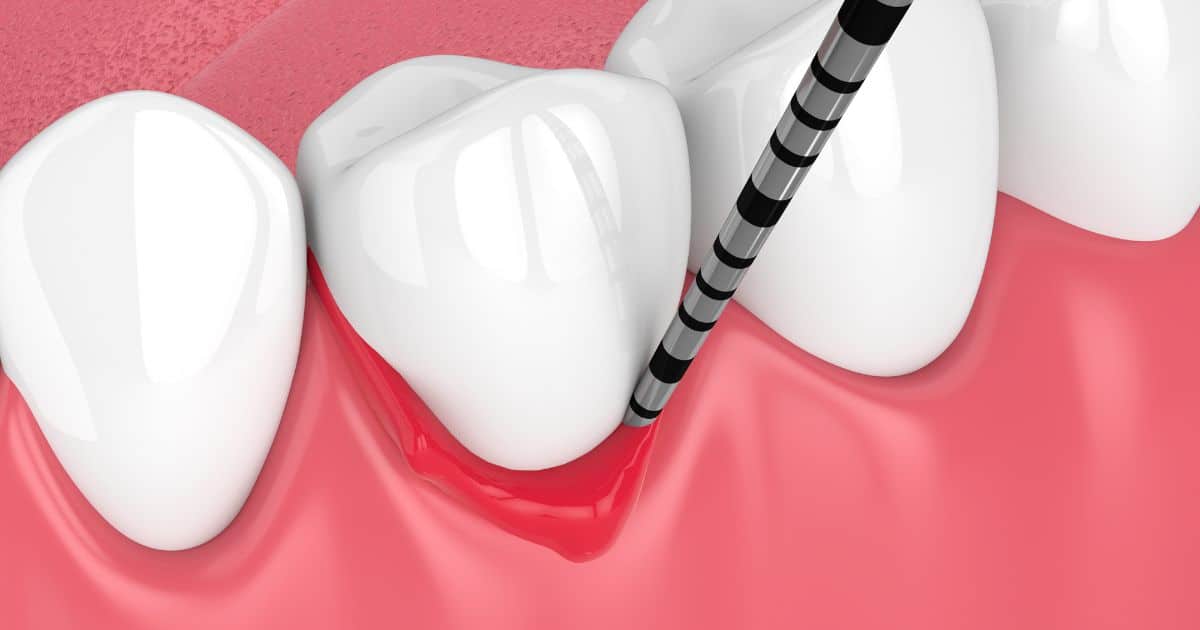 Periodontitis crónica