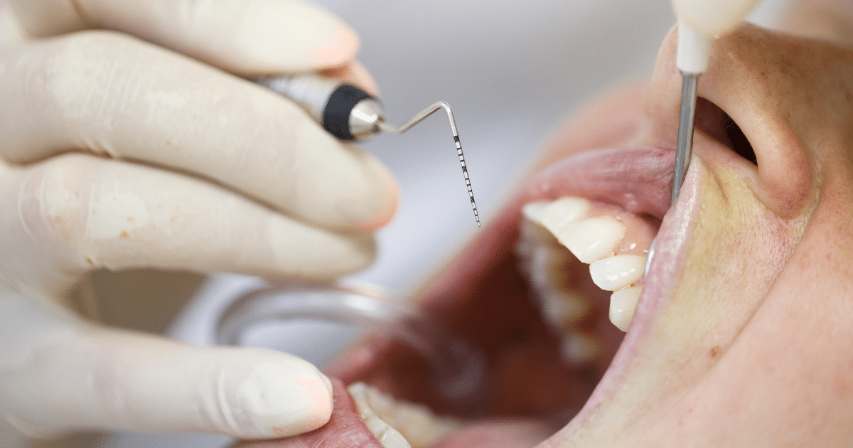 Periodontitis