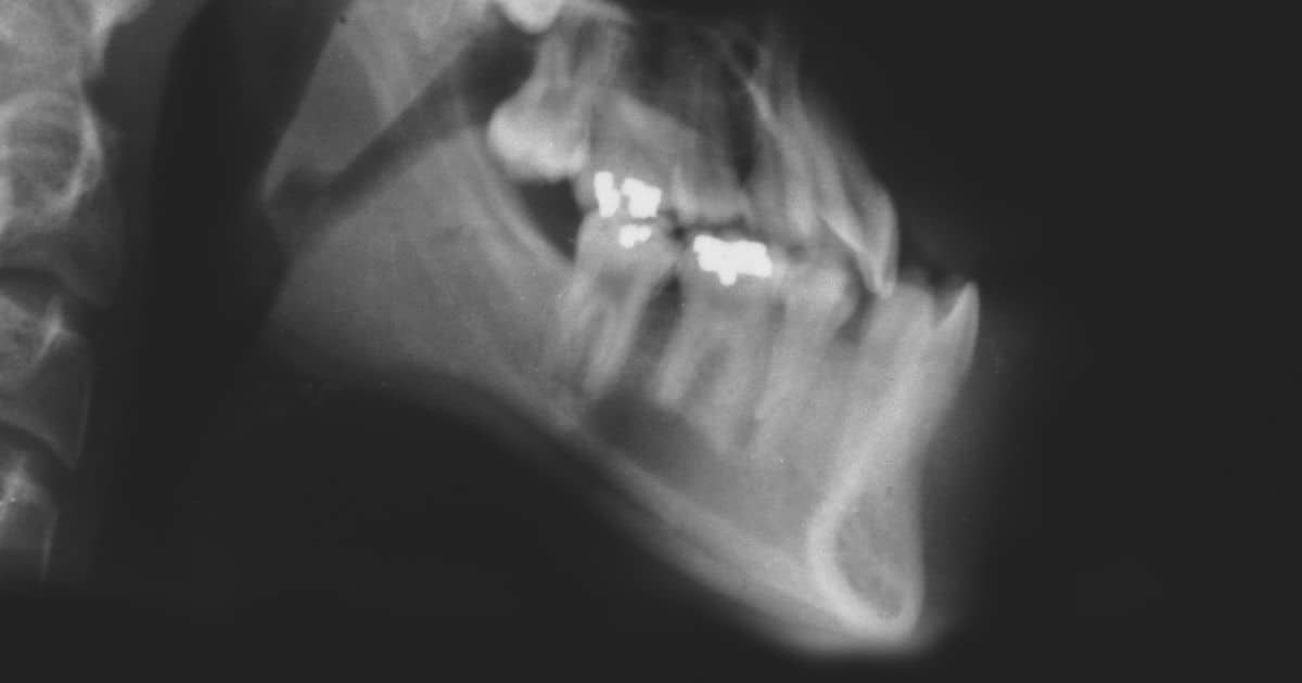 Prognatismo mandibular