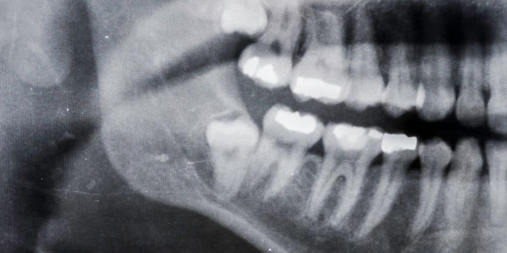 quiste dentígero