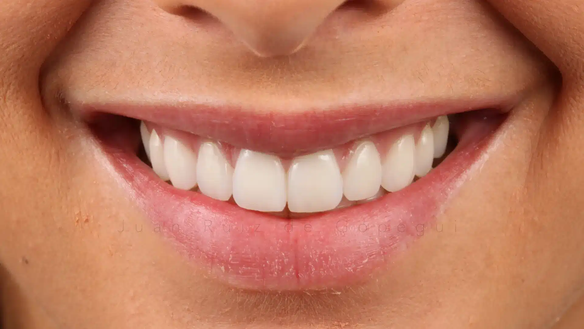 Carillas de Composite - Clínica Ruiz de Gopegui Primer plano de la sonrisa corregida tras el cierre de diastemas mediante blanqueamiento y carillas aditivas sin preparación.