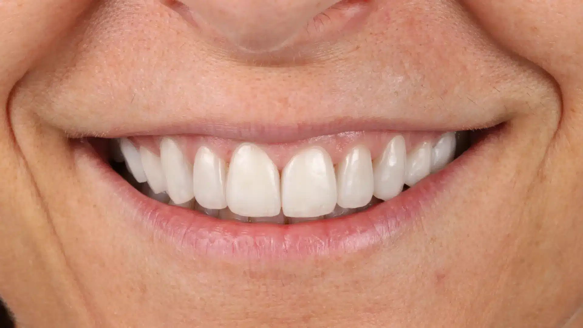 Sonrisa restaurada con carillas de porcelana de aspecto natural y brillante tras corregir la tinción por tetraciclinas mediante el concepto Esthetic Integration Area.