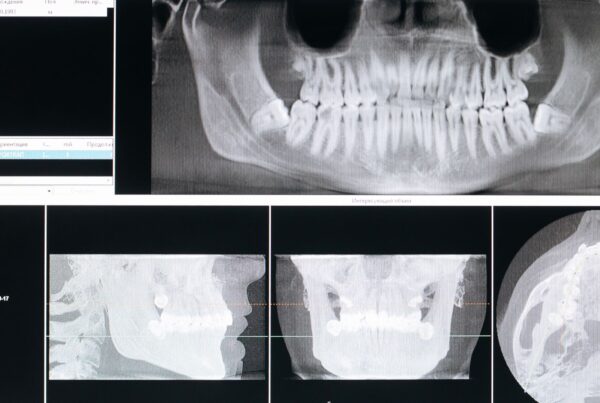 Diagnóstico de periodontitis asistido por inteligencia artificial