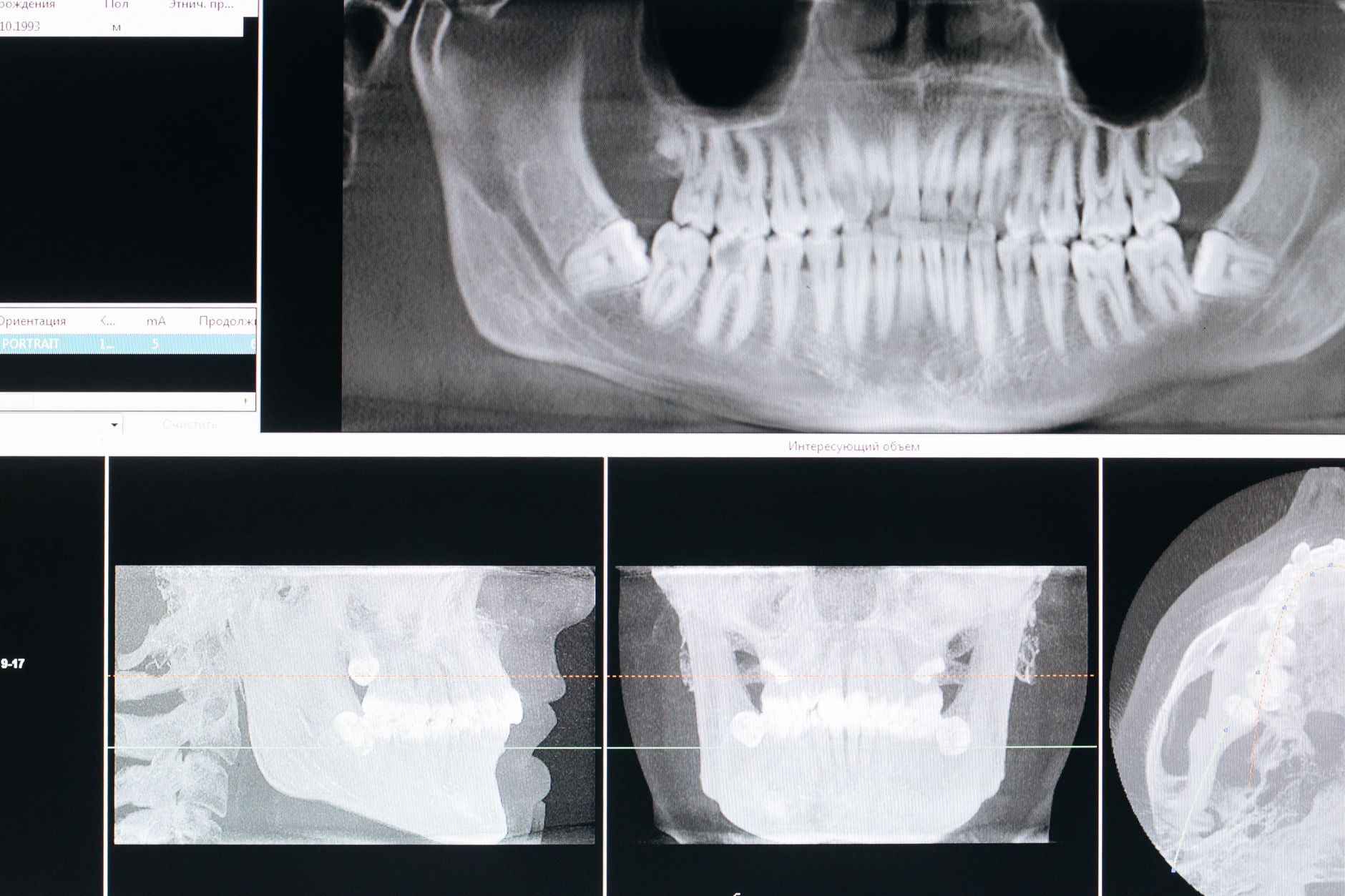 Diagnóstico de periodontitis asistido por inteligencia artificial