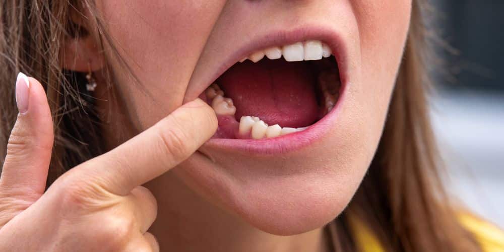 avulsión dental